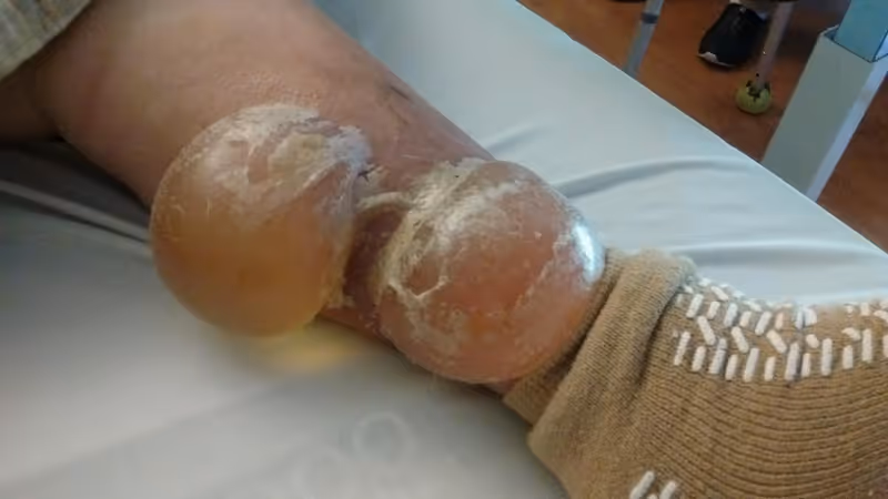 Close-up of a patient's leg with a large wound in a hospital bed.